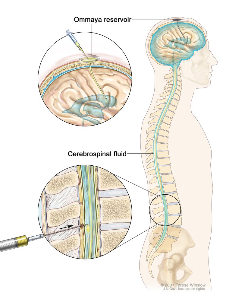 Intrathecal chemotherapy; drawing shows the cerebrospinal fluid (CSF) in the brain and spinal cord, and an Ommaya reservoir (a dome-shaped container that is placed under the scalp during surgery; it holds the drugs as they flow through a small tube into the brain). Top section shows a syringe and needle injecting anticancer drugs into the Ommaya reservoir. Bottom section shows a syringe and needle injecting anticancer drugs directly into the cerebrospinal fluid in the lower part of the spinal column.